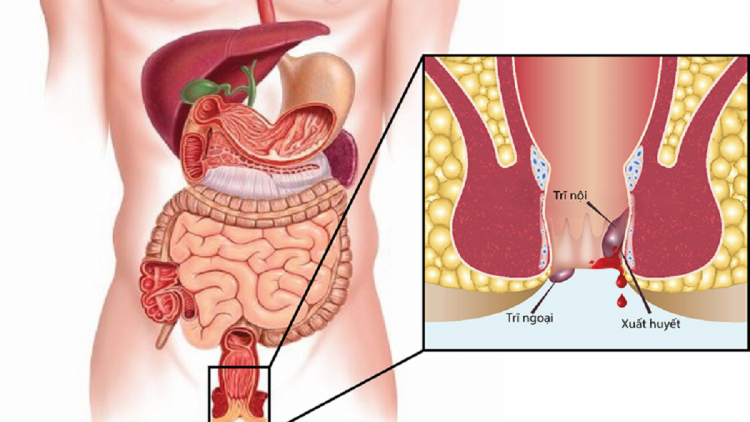 ác biện pháp khắc phục bệnh trĩ tại nhà